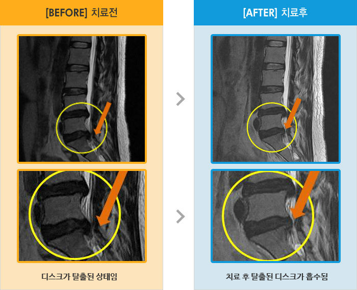목동자생한방병원 치료사례 MRI로 보는 치료결과-양측 허리통증과 다리 통증, 저림