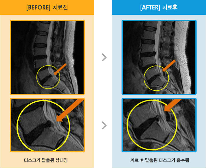목동자생한방병원 치료사례 MRI로 보는 치료결과-양쪽 허리 통증 및 우측 다리 경직되고 저림 증상