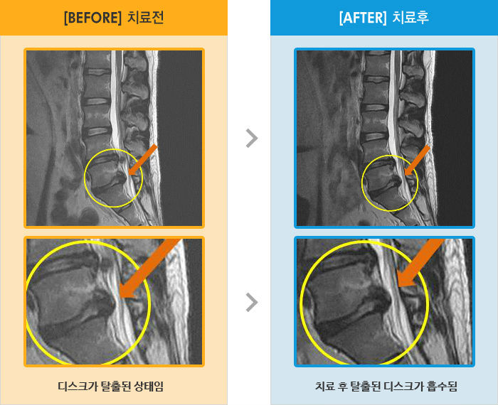 목동자생한방병원 치료사례 MRI로 보는 치료결과-일어서서 걸을때 왼쪽 엉덩이 무릎 발목 통증