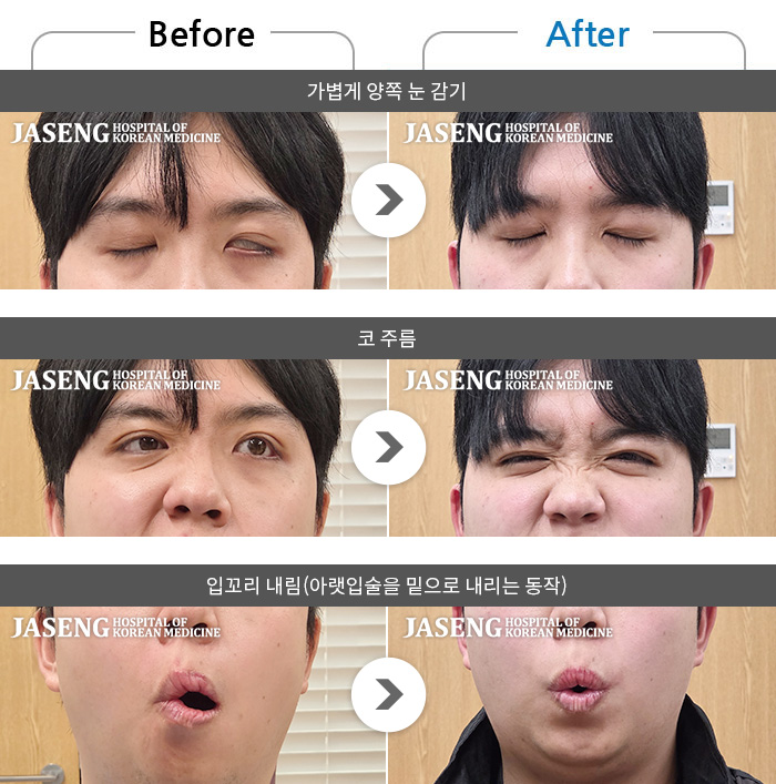 �ڻ��ѹ溴�� ġ���� �ȸ�Ű渶�� ġ����-���� �ӹ����� ������ ����� ���� �󱼿� ���� �Ծ��.