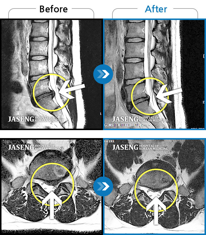 목동자생한방병원 치료사례 MRI로 보는 치료결과-허리 골반 통증이 심해 걸을 수 없었다.