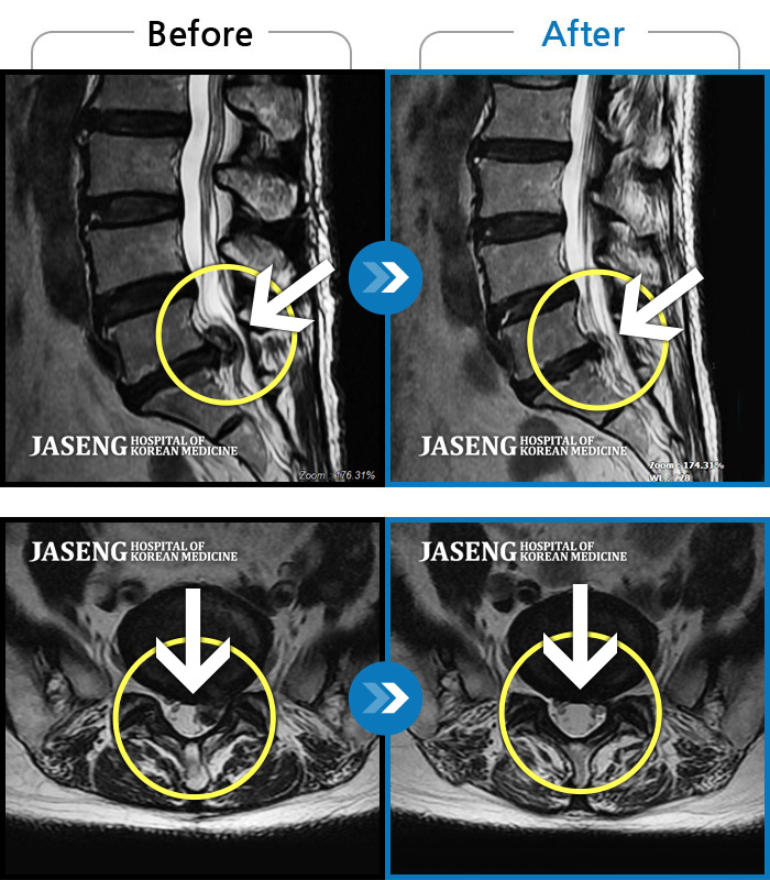 목동자생한방병원 치료사례 MRI로 보는 치료결과-왼쪽 허벅지부터 발가락까지 아프고 저려 일상생활 불가능한 상태