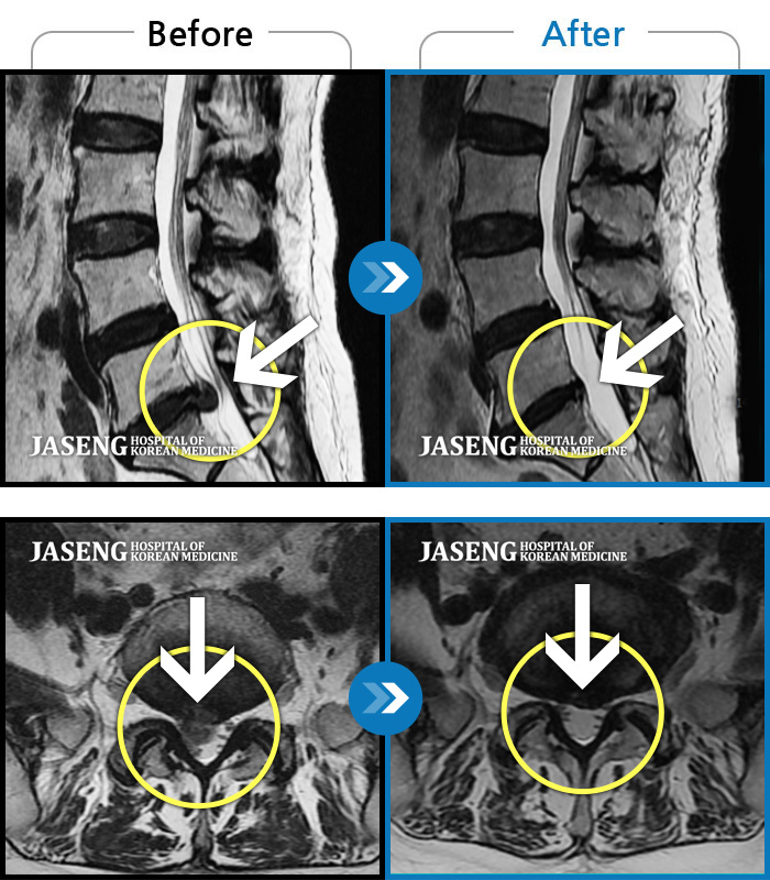 목동자생한방병원 치료사례 MRI로 보는 치료결과-허리 통증과 우측 하지 방사통 극심한 상태