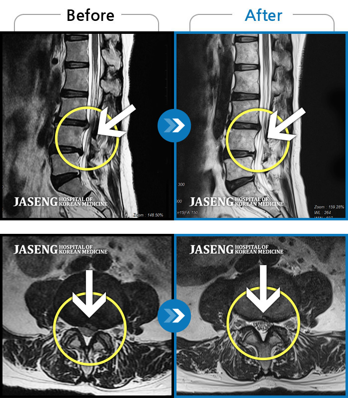 목동자생한방병원 치료사례 MRI로 보는 치료결과-허리 골반이 아프고 우측 종아리가 저림