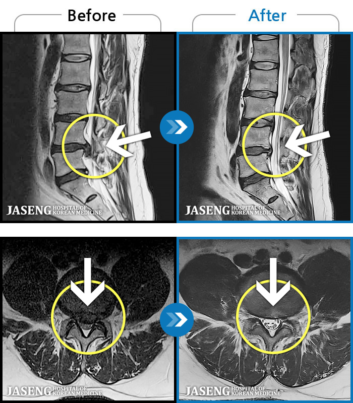 ������ڻ��ѹ溴�� ġ���� MRI�� ���� ġ����-���� ����ο��� �����߰��� ������ ������.
