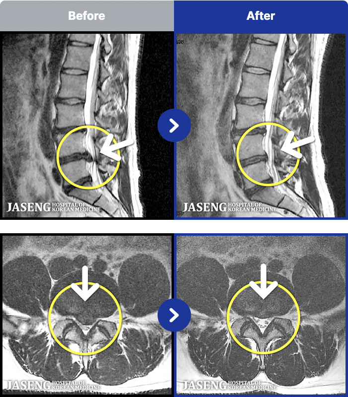 �����ڻ����ǿ� ġ���� MRI�� ���� ġ����-���� �߰��� Ż�������� ���� �㸮 ������ �Բ� �ٸ� ������ΰ� ���� ���ļ� ������ �Ұ����� ���·� ����