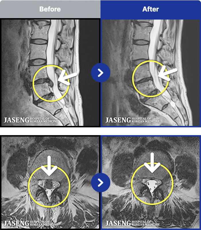 �����ڻ����ǿ� ġ���� MRI�� ���� ġ����-�㸮�� ���� �ٸ��� ���� ����