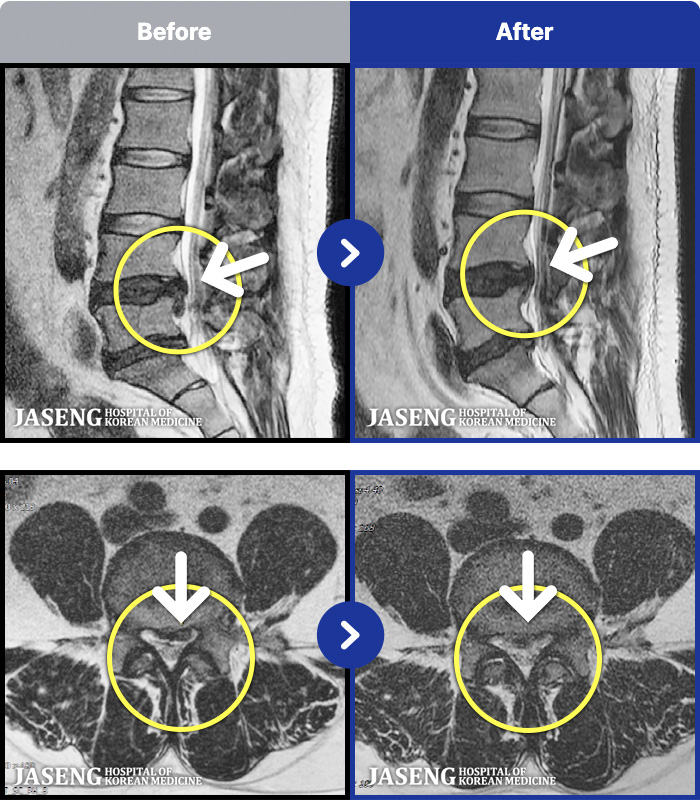 �ڻ��ѹ溴�� ġ���� MRI�� ���� ġ����-������ ���ϰ� ���� �ٸ� ������ ���� ���� �׸��� ���� �߰��� �ٷ� ���Ϸ� �ϻ��Ȱ�� ����� ���¿����ϴ�.