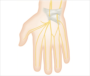 목동자생한방병원 기타관절질환 손목터널증후군-손목터널증후군에 관련된 이미지 입니다.