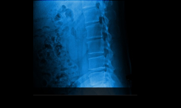 목동자생한방병원 허리질환 척추후만증-척추후만증에 관련된 이미지 입니다.